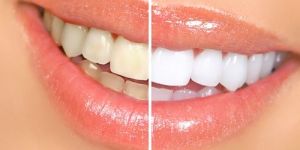 Teeth Whitening Service in Pune