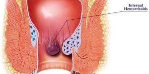 Piles Treatment Services
