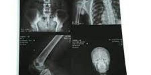 inkjet x-ray film
