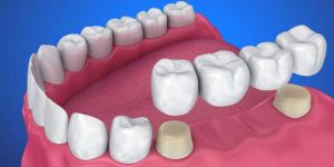 Crown, Bridges and Dentures