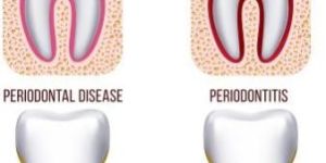 Gum Care Treatment