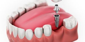 Implant Procedure