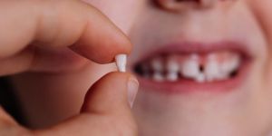 Tooth Extraction