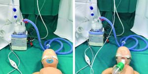 Neonatal High Flow Nasal Cannula