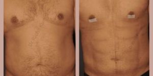 Gynecomastia Surgery