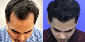Hair Transplantation