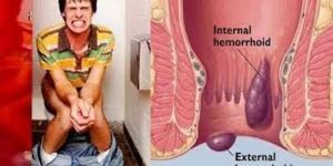 Piles Treatment Service