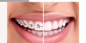 Invisalign Services
