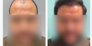 Hair Transplant Service