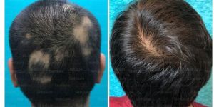 Hair Transplantation