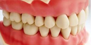 FRASACO AG-3 SCREW DRIVER TYPODONT JAW SET