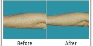 Arms Hair Removal Services