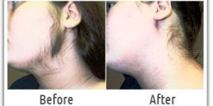 Laser Hair Removal Treatment