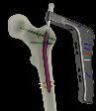 Proximal Femoral Nail