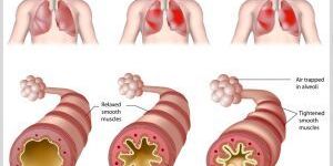 Asthma and Allergy Treatment