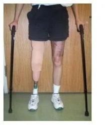 BELOW KNEE ARTIFICIAL LIMBS