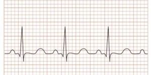 ECG Chart Paper