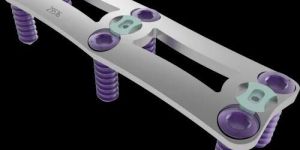 Anterior Cervical Plate