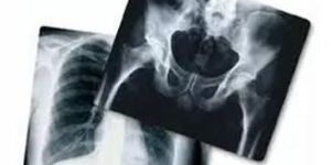 Carestream Kodak Dental X Ray Films