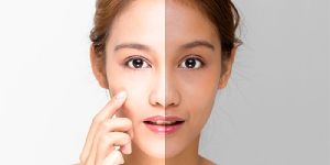 Skin Whitening Treatment