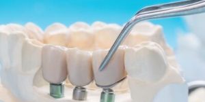 Dental Crown & Bridges Treatment Services