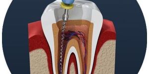 Root Canal Treatment Services
