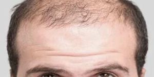 Male Pattern Baldness Treatment