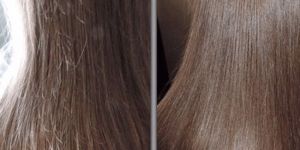 Ozone Therapy for Hair Strengthning