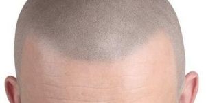 Scalp Micropigmentation Treatment