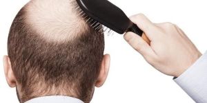 Unshaven FUE Hair Transplant