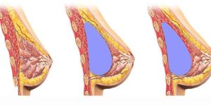 Breast Implant Surgery