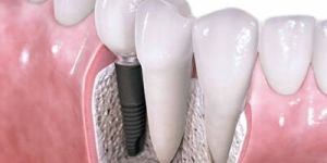 Dental Implant Surgery Service