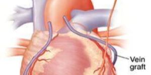 Heart Surgery Services