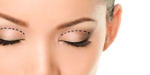 Blepharoplasty Surgery
