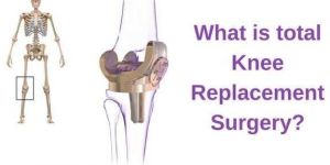 Knee Replacement Surgery