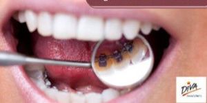 Lingual Braces Services