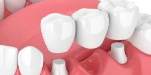 Dental Bridges