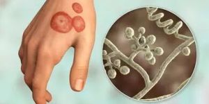 Ringworm Infection Treatment