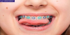 Metal Braces