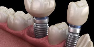 Dental Implant Surgery