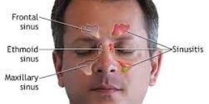 Sinusitis Treatment
