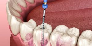 Root Canal Treatment