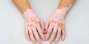 Vitiligo Treatment