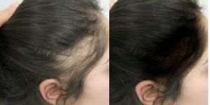 Hair Growth Serum