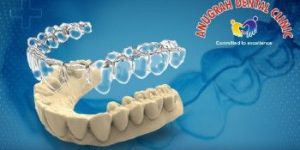 Invisalign Aligners