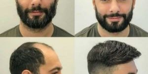Hair Patch Fixing Services