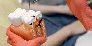 Root Canal Treatment Service
