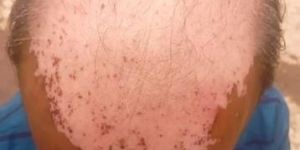 Hair Problem Ayurvedic Oil