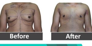 Gynecomastia Surgery