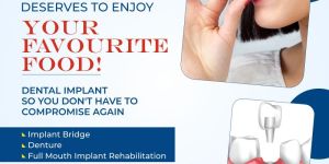 Dental Implant Service